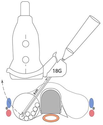 A novel guided approach to radiofrequency ablation of thyroid nodules: the Toronto Sunnybrook experience